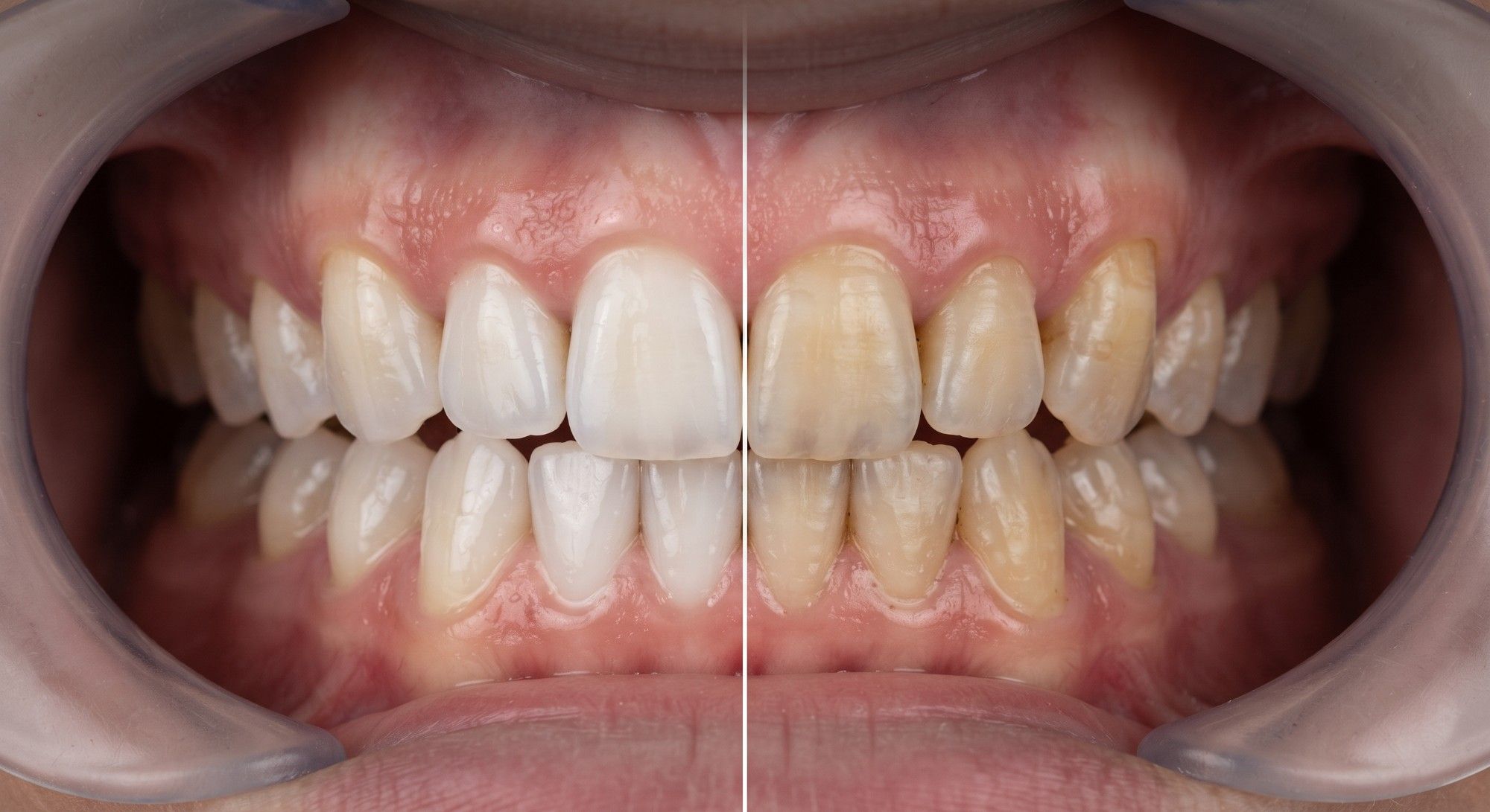 نتیجه‌ی واقعی بلیچینگ در مطب؛ سمت راست قبل و سمت چپ بعد